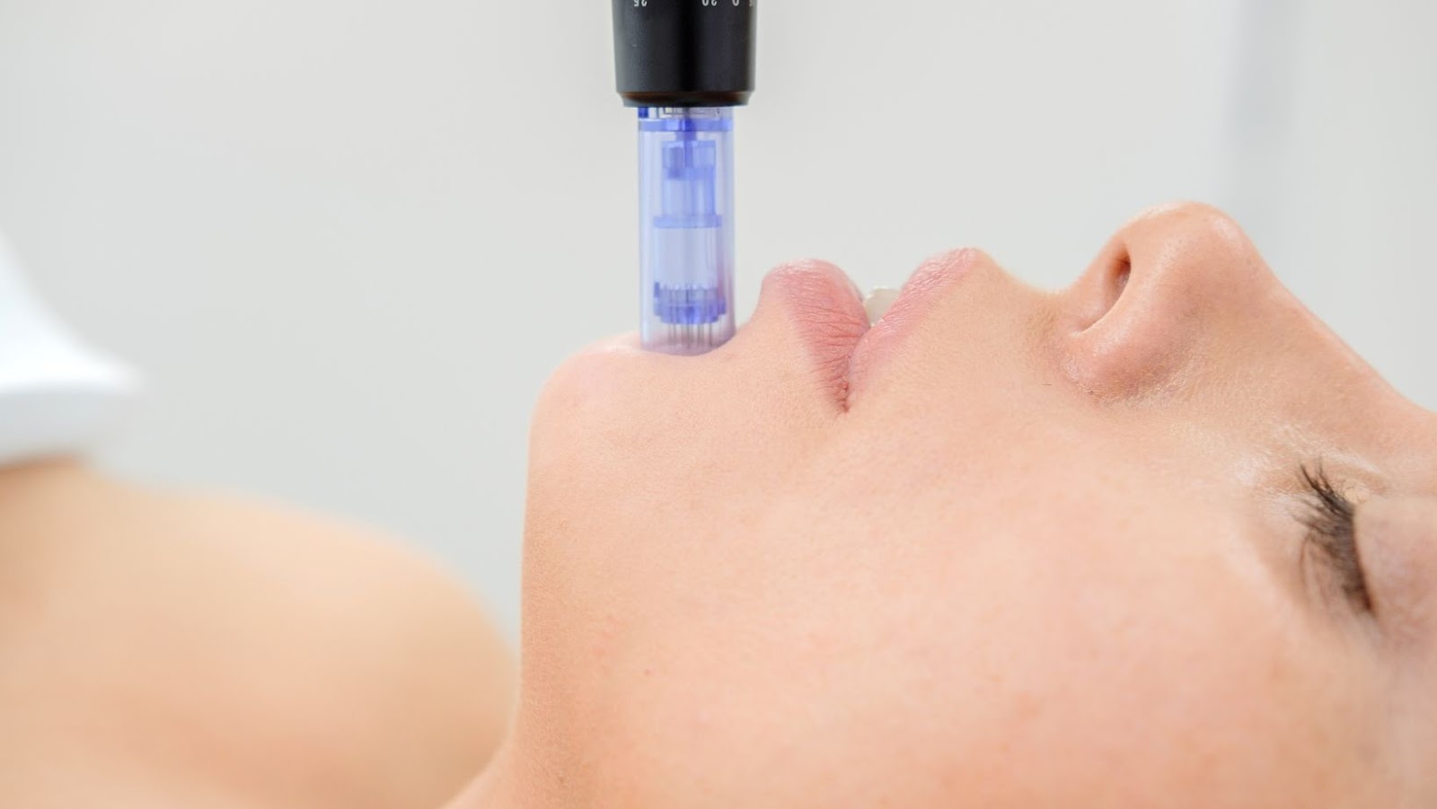 Mesotherapy can improve facial appearance (1)