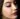 Rhinoplasty Cost