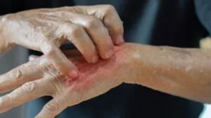 uyuzun bittiğini nasıl anlarız